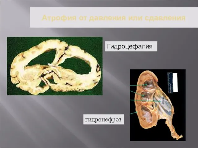 Атрофия от давления или сдавления Гидроцефалия гидронефроз