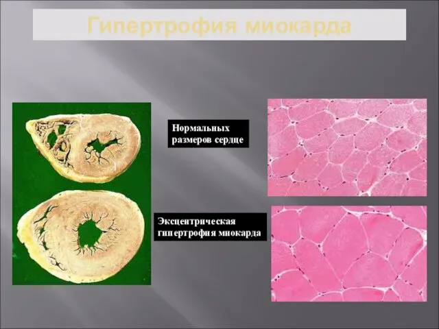 Гипертрофия миокарда Нормальных размеров сердце Эксцентрическая гипертрофия миокарда