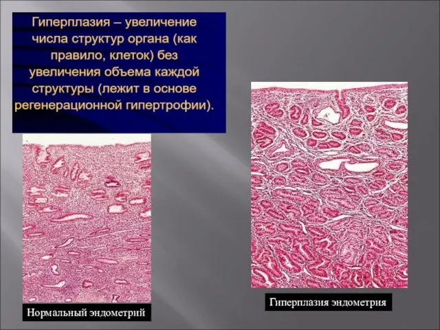 Нормальный эндометрий Гиперплазия эндометрия