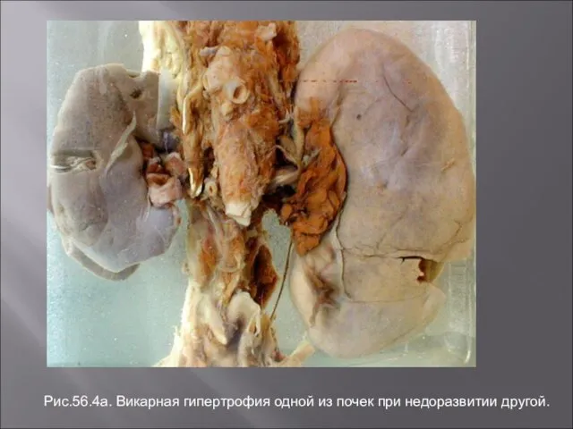 Рис.56.4а. Викарная гипертрофия одной из почек при недоразвитии другой.