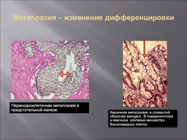 Метаплазия – изменение дифференцировки Переходноклеточная метаплазия в предстательной железе. Кишечная метаплазия