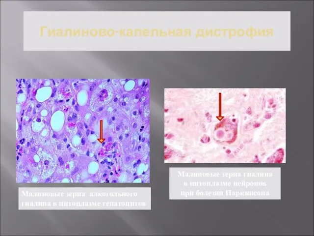 Гиалиново-капельная дистрофия Малиновые зерна алкогольного гиалина в цитоплазме гепатоцитов Малиновые зерна
