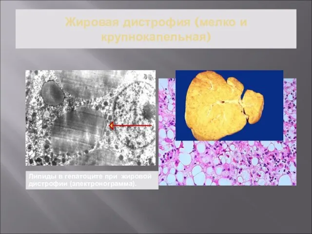 Жировая дистрофия (мелко и крупнокапельная) Липиды в гепатоците при жировой дистрофии (электронограмма).