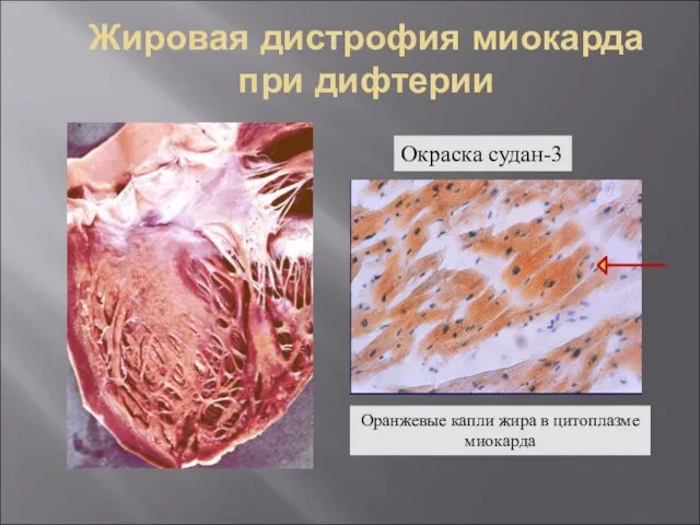 Жировая дистрофия миокарда при дифтерии Оранжевые капли жира в цитоплазме миокарда Окраска судан-3