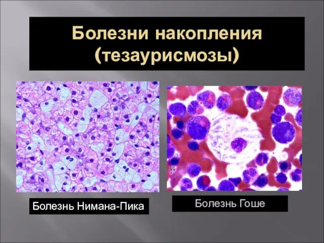 Болезни накопления (тезаурисмозы) Болезнь Нимана-Пика Болезнь Гоше