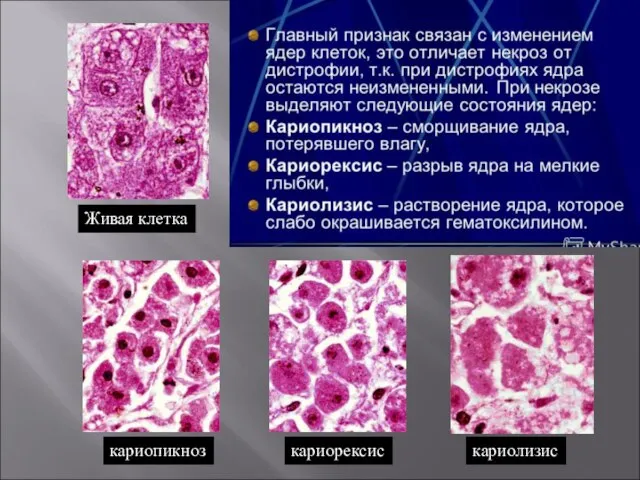 Живая клетка кариопикноз кариорексис кариолизис