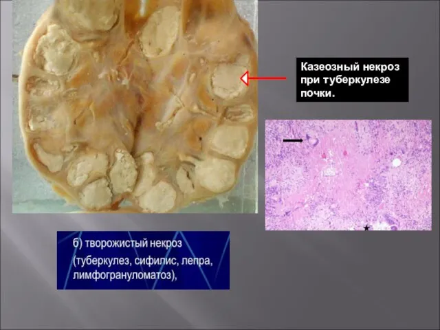 Казеозный некроз при туберкулезе почки.