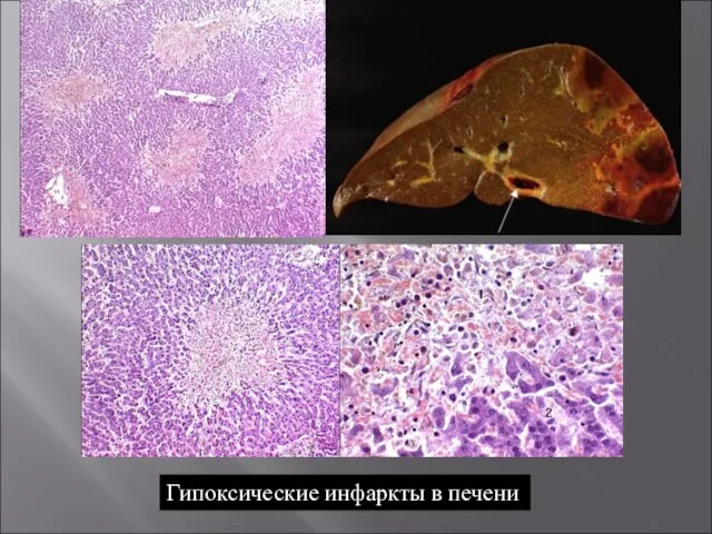 Гипоксические инфаркты в печени