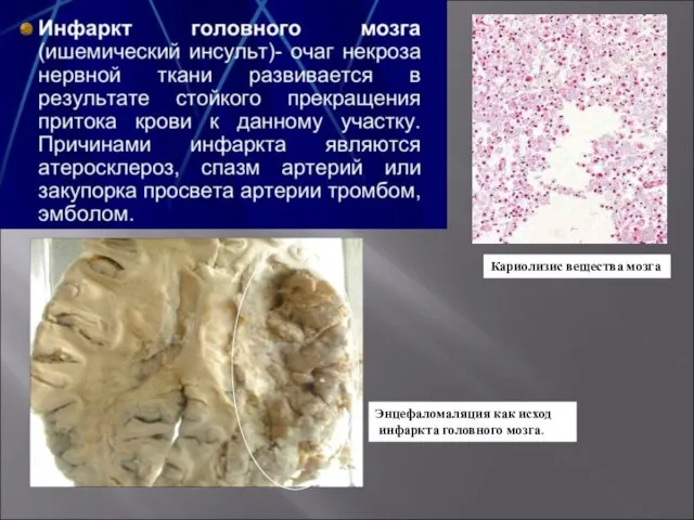 Кариолизис вещества мозга Энцефаломаляция как исход инфаркта головного мозга.