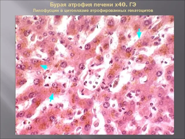 Бурая атрофия печени х40. ГЭ Липофусцин в цитоплазме атрофированных гепатоцитов