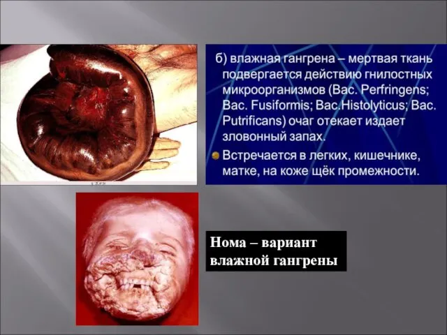 Нома – вариант влажной гангрены