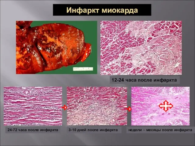 Инфаркт миокарда 12-24 часа после инфаркта 24-72 часа после инфаркта 3-10