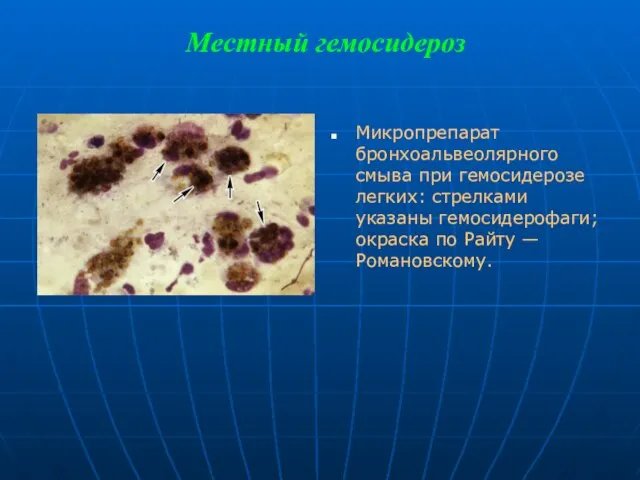 Местный гемосидероз Микропрепарат бронхоальвеолярного смыва при гемосидерозе легких: стрелками указаны гемосидерофаги; окраска по Райту — Романовскому.