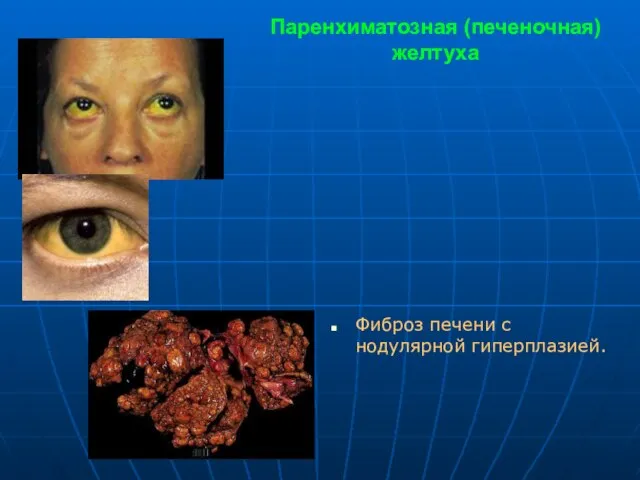 Паренхиматозная (печеночная) желтуха Фиброз печени с нодулярной гиперплазией.