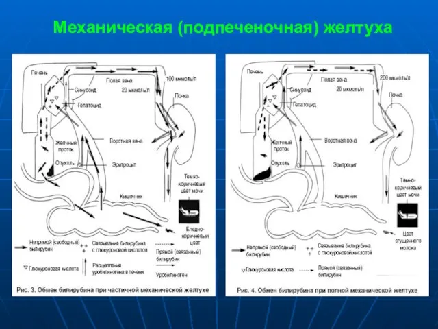 Механическая (подпеченочная) желтуха