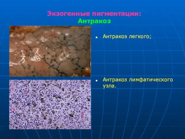 Экзогенные пигментации: Антракоз Антракоз легкого; Антракоз лимфатического узла.