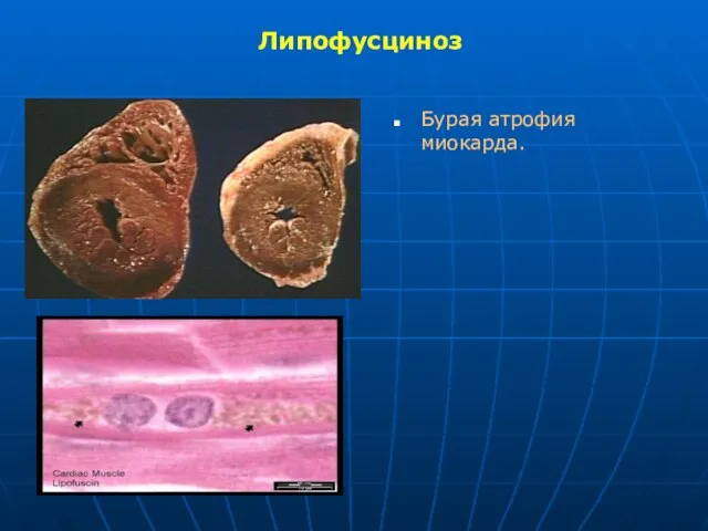 Липофусциноз Бурая атрофия миокарда.