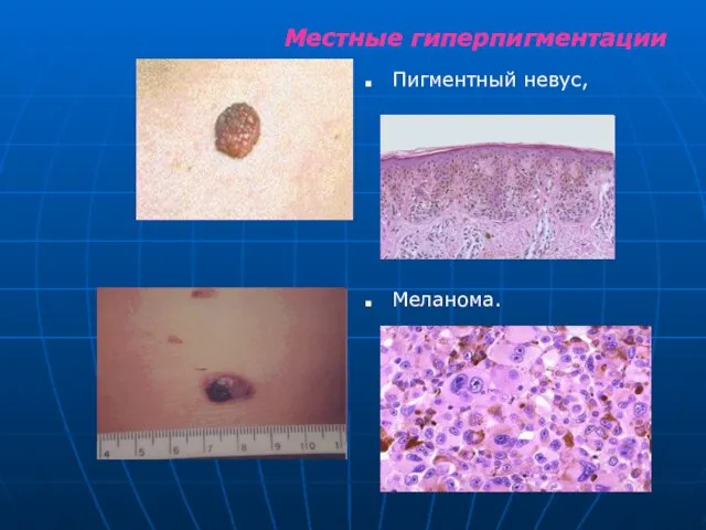 Местные гиперпигментации Пигментный невус, Меланома.