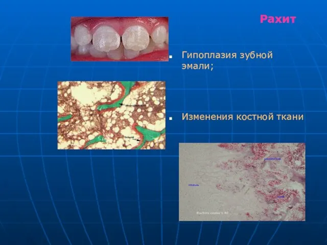 Рахит Гипоплазия зубной эмали; Изменения костной ткани