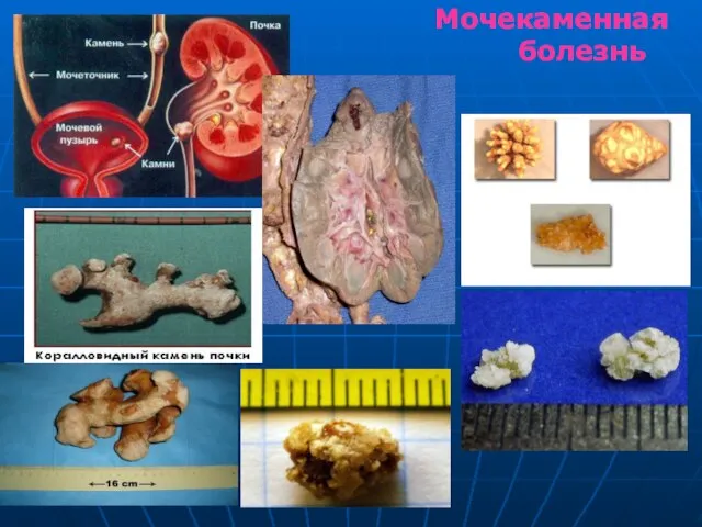 Мочекаменная болезнь