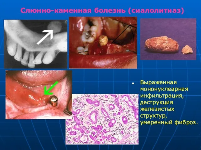 Слюнно-каменная болезнь (сиалолитиаз) Выраженная мононуклеарная инфильтрация, деструкция железистых структур, умеренный фиброз.