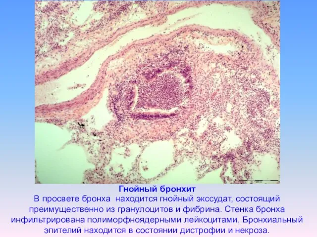 Гнойный бронхит В просвете бронха находится гнойный экссудат, состоящий преимущественно из