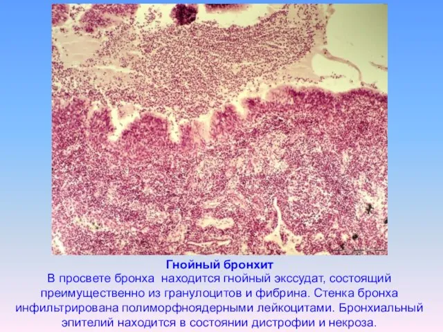 Гнойный бронхит В просвете бронха находится гнойный экссудат, состоящий преимущественно из