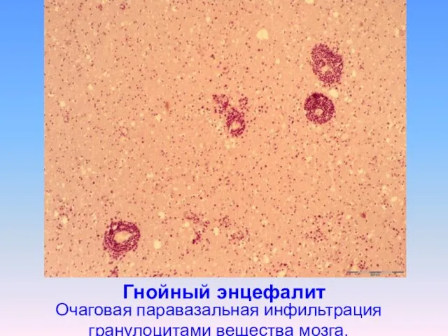 Гнойный энцефалит Очаговая паравазальная инфильтрация гранулоцитами вещества мозга.