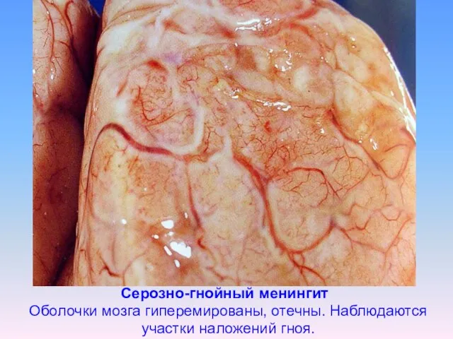 Серозно-гнойный менингит Оболочки мозга гиперемированы, отечны. Наблюдаются участки наложений гноя.