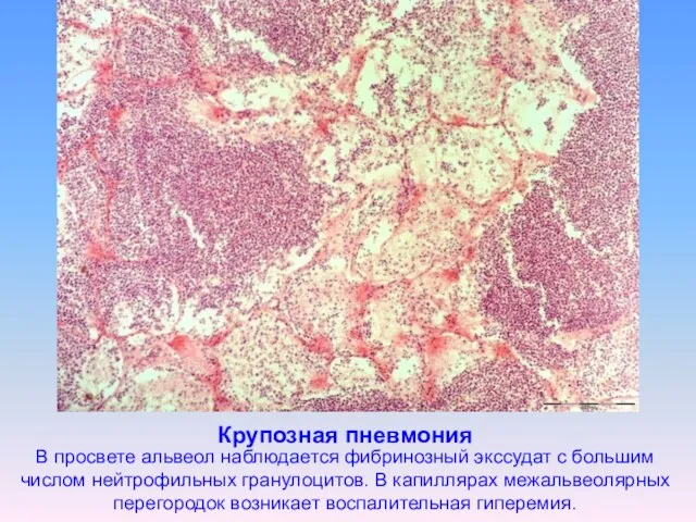 Крупозная пневмония В просвете альвеол наблюдается фибринозный экссудат с большим числом