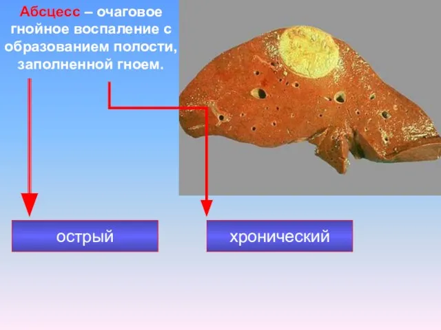 Абсцесс – очаговое гнойное воспаление с образованием полости, заполненной гноем. острый хронический