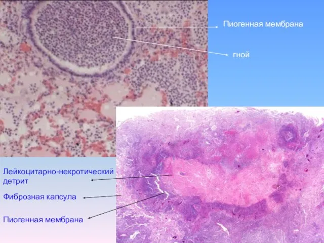 Пиогенная мембрана гной Лейкоцитарно-некротический детрит Фиброзная капсула Пиогенная мембрана