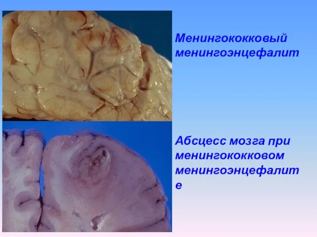 Абсцесс мозга при менингококковом менингоэнцефалите Менингококковый менингоэнцефалит