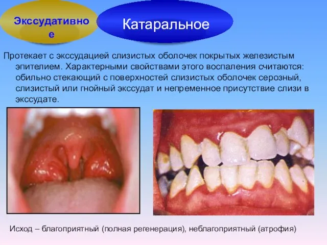 Протекает с экссудацией слизистых оболочек покрытых железистым эпителием. Характерными свойствами этого