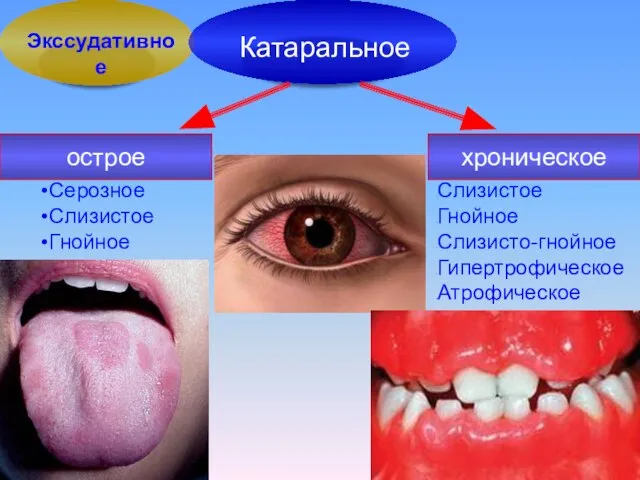 острое хроническое Серозное Слизистое Гнойное Слизистое Гнойное Слизисто-гнойное Гипертрофическое Атрофическое