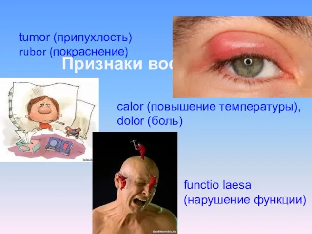 tumor (припухлость) rubor (покраснение) Признаки воспаления calor (повышение температуры), dolor (боль) functio laesa (нарушение функции)