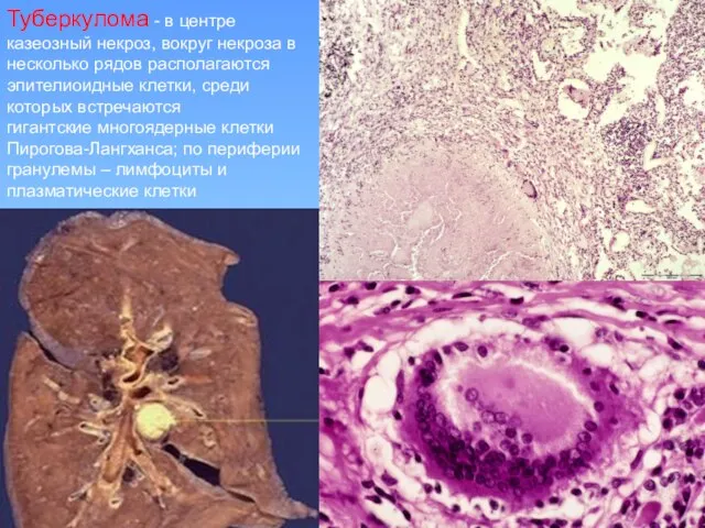 Туберкулома - в центре казеозный некроз, вокруг некроза в несколько рядов