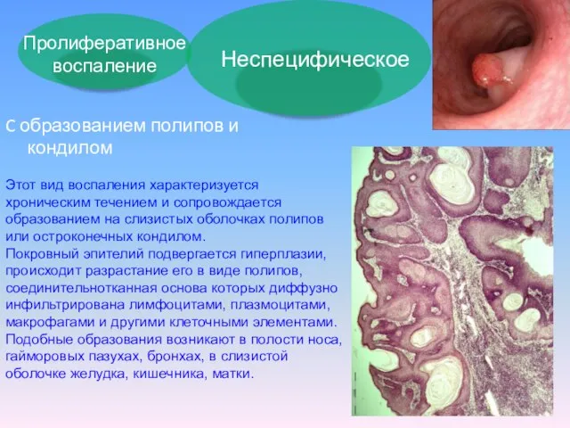Неспецифическое C образованием полипов и кондилом Этот вид воспаления характеризуется хроническим