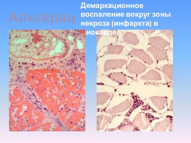 Альтерация Демаркационное воспаление вокруг зоны некроза (инфаркта) в миокарде