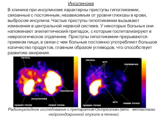 Инсулинома В клинике при инсулиноме характерны приступы гипогликемии, связанные с постоянным,