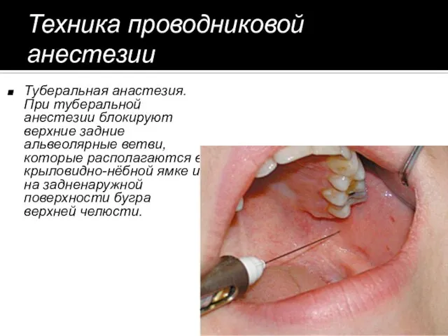 Техника проводниковой анестезии Туберальная анастезия. При туберальной анестезии блокируют верхние задние