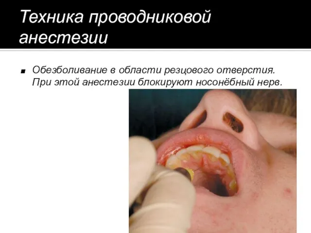 Техника проводниковой анестезии Обезболивание в области резцового отверстия.При этой анестезии блокируют носонёбный нерв.