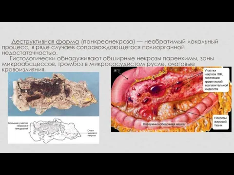 Деструктивная форма (панкреонекроза) — необратимый локальный процесс, в ряде случаев сопровождающегося