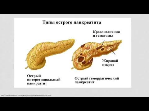 http://bezpankreatita.ru/simptomy/ostryj-pankreatit-simptomy.html