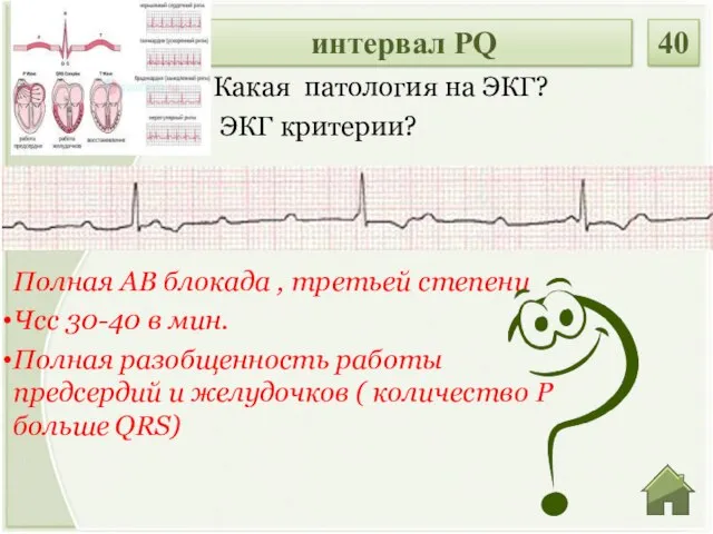 Полная АВ блокада , третьей степени Чсс 30-40 в мин. Полная