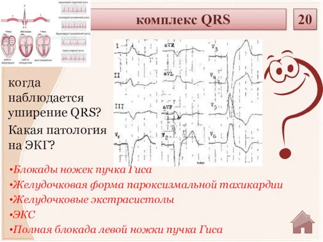 Блокады ножек пучка Гиса Желудочковая форма пароксизмальной тахикардии Желудочковые экстрасистолы ЭКС