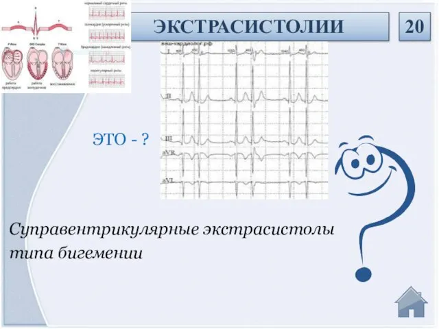 Суправентрикулярные экстрасистолы типа бигемении ЭТО - ? ЭКСТРАСИСТОЛИИ 20