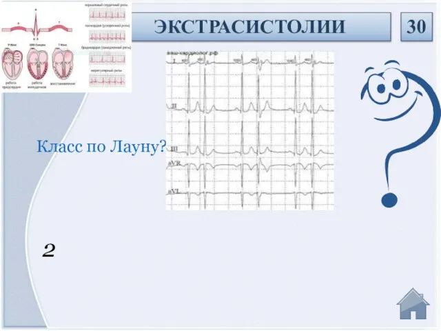 2 Класс по Лауну? ЭКСТРАСИСТОЛИИ 30