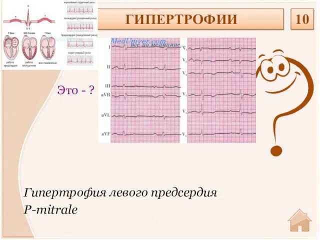 Гипертрофия левого предсердия P-mitrale Это - ? ГИПЕРТРОФИИ 10