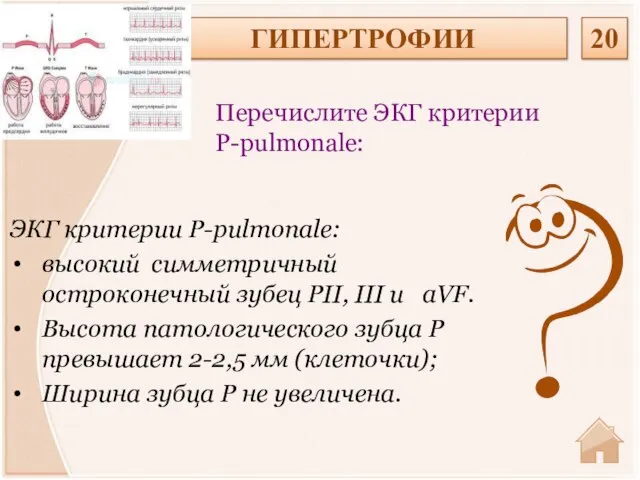 ЭКГ критерии P-pulmonale: высокий симметричный остроконечный зубец PII, III и aVF.